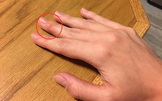 How to Get Rid of Writer's Callus Without Irritating Your Skin