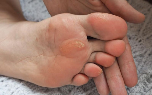 How to use the callus shaver safely and effectively at home