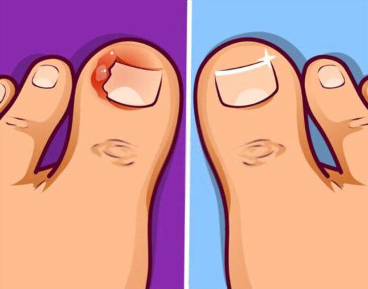 Healthy Feet: The Ultimate Ingrown Toenail Prevention and Care Guide