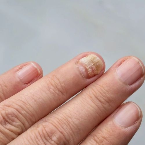 What is nail fungus and how to actually protect yourself