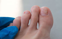 Why Is My Nail Thick? Common Causes, Treatments
